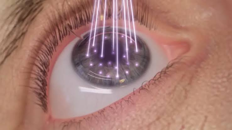 Confira – Cirurgia Refrativa procedimento que pode eliminar uso de óculos