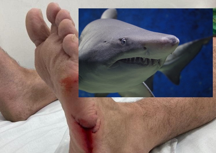 Surfista é mordido por tubarão mangona em Navegantes