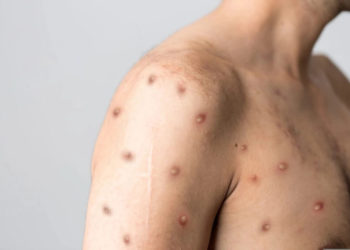 Confirmado primeiro caso de varíola dos macacos em Balneário Camboriú