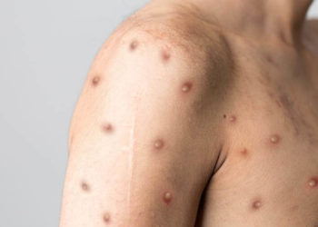 Balneário Camboriú chega a 31 casos de varíola dos macacos