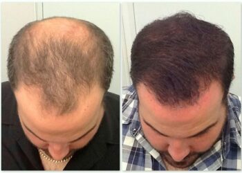 É possível realizar transplante capilar em casos de calvície avançada?