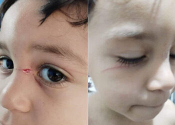 Criança é ferida por linha de cerol em Balneário Camboriú: “Por pouco não ficou cego”