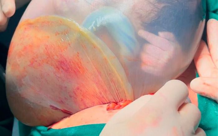 HOSPITAL MARIETA REGISTRA DOIS RAROS NASCIMENTOS DE GÊMEOS EMPILICADOS EM MENOS DE 48 HORAS