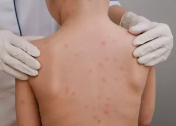 Santa Catarina registra caso de meningite bacteriana em criança