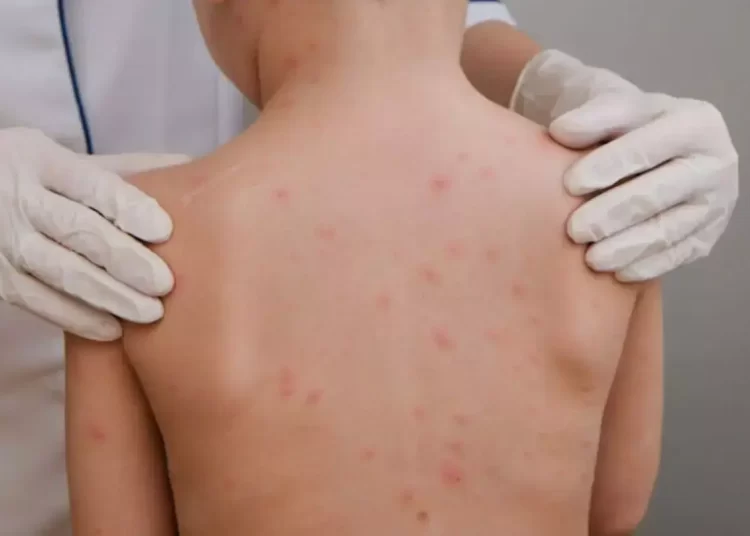 Santa Catarina registra caso de meningite bacteriana em criança