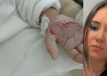 Madrasta que queimou a mão de criança é presa em Itapema